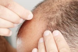 FDA warns unapproved hair-loss product finasteride tied to side effects